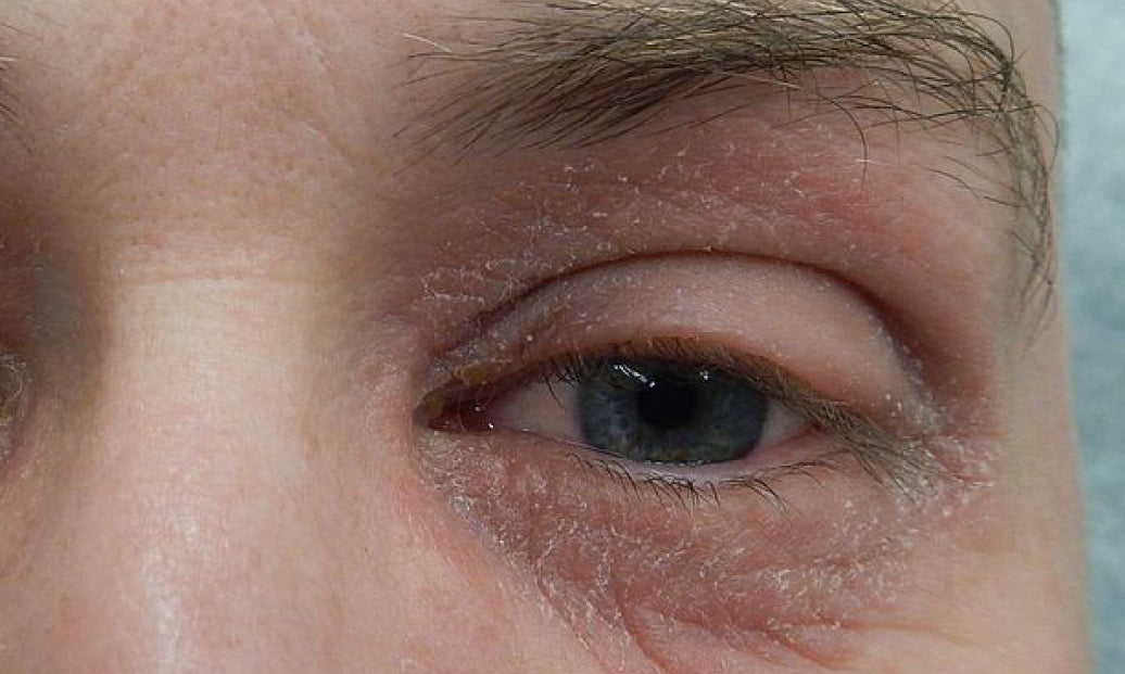 Periocular dermatitis around the eyes