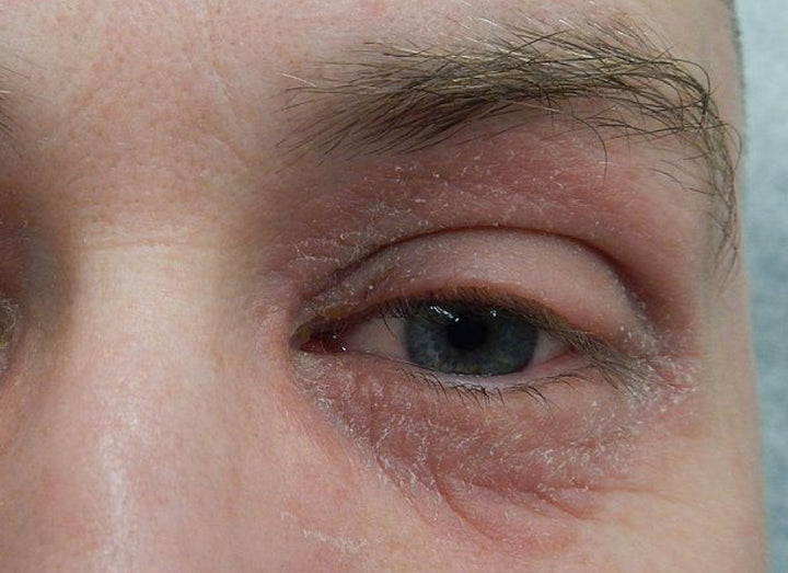 Periocular dermatitis around the eyes