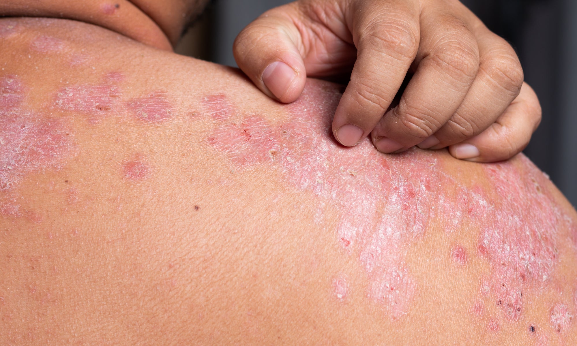 What Does Psoriasis Look Like?