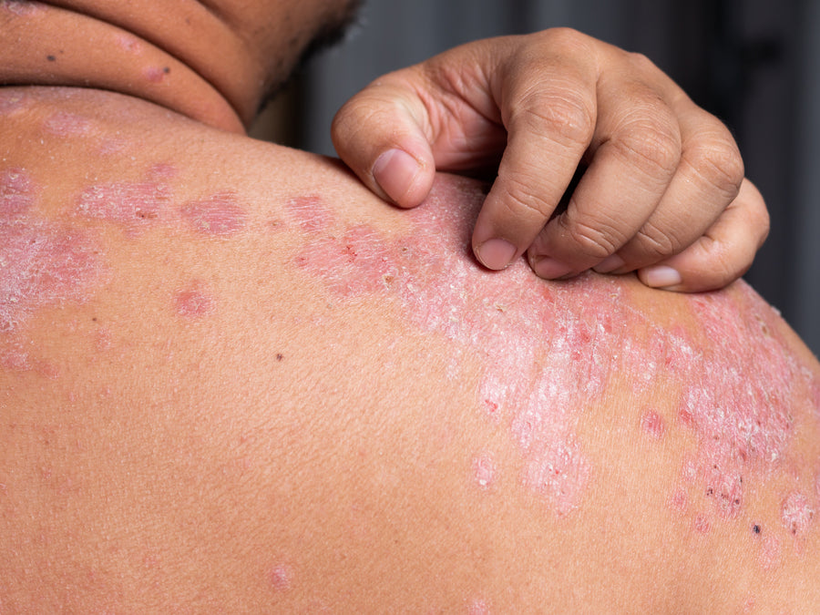 What Does Psoriasis Look Like?