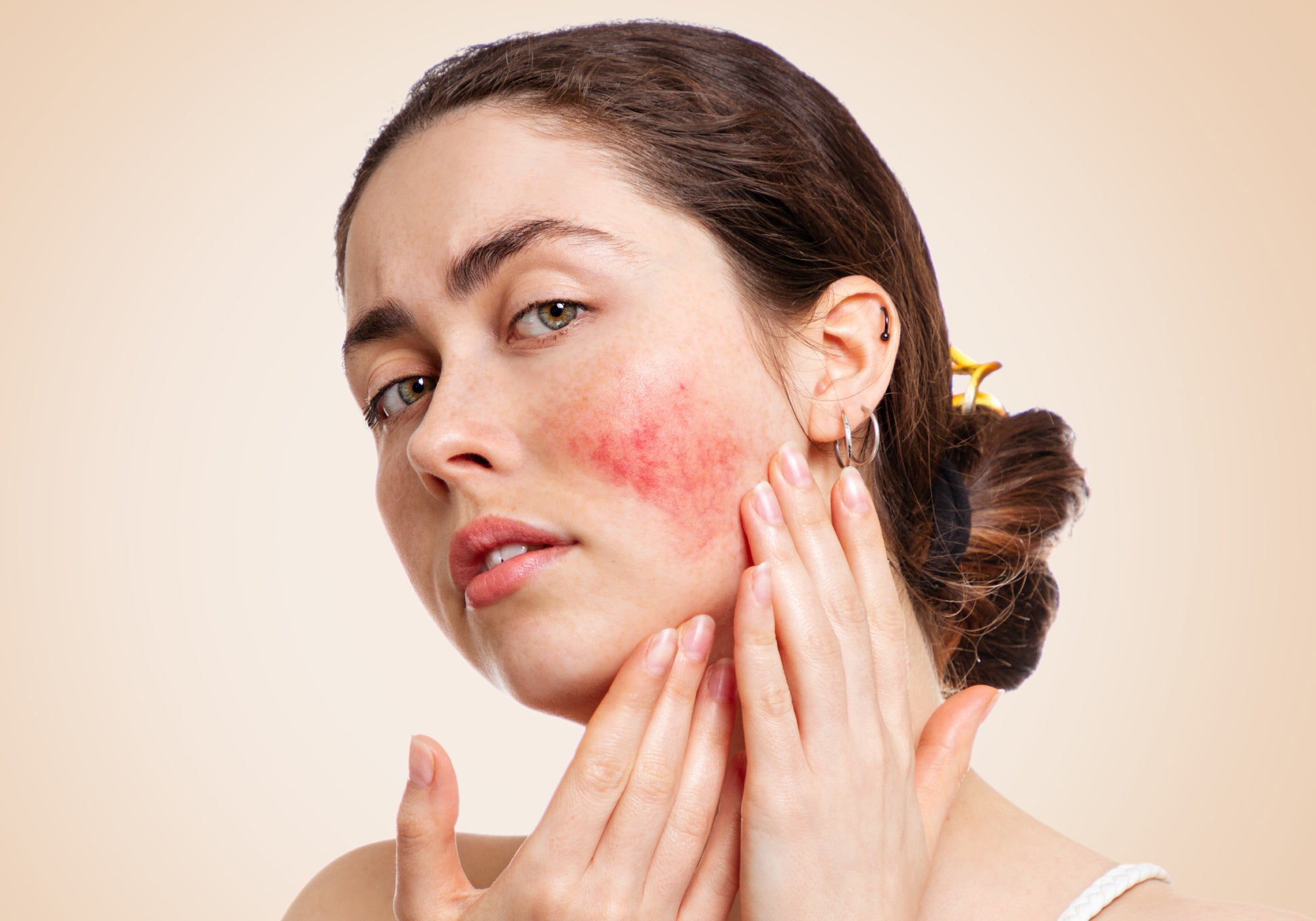 What Does Rosacea On Your Face Look Like?