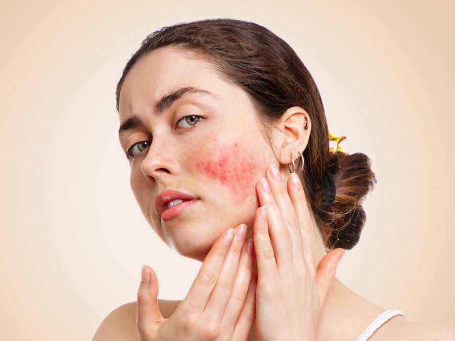 What Does Rosacea On Your Face Look Like?