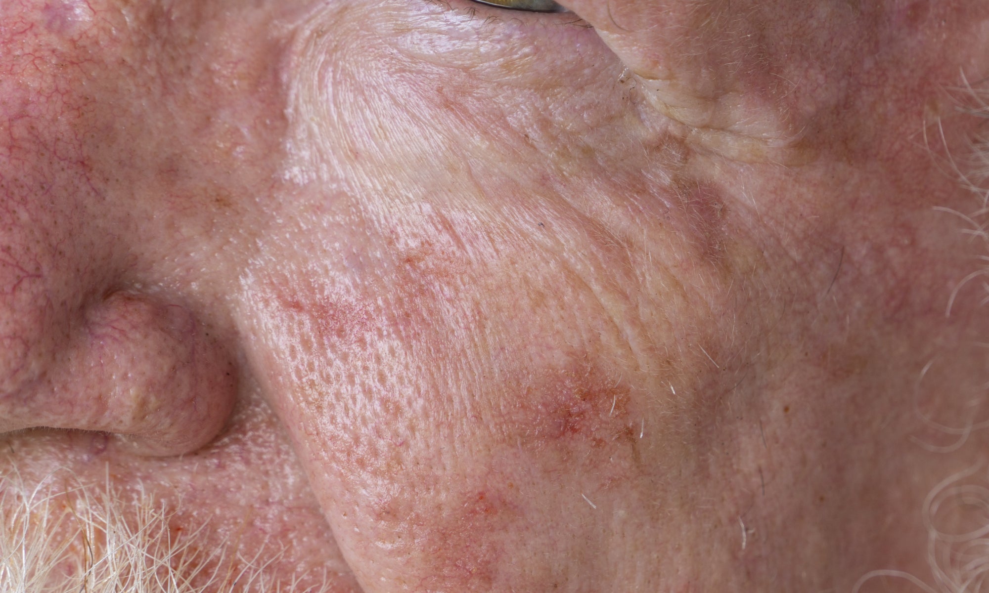 An example of Actinic Keratosis on the face