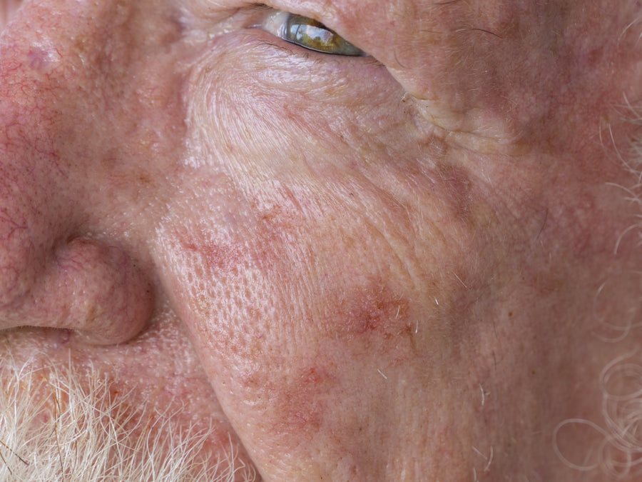 An example of Actinic Keratosis on the face