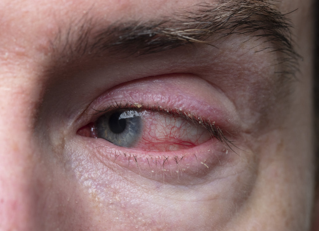 Example of Blepharitis