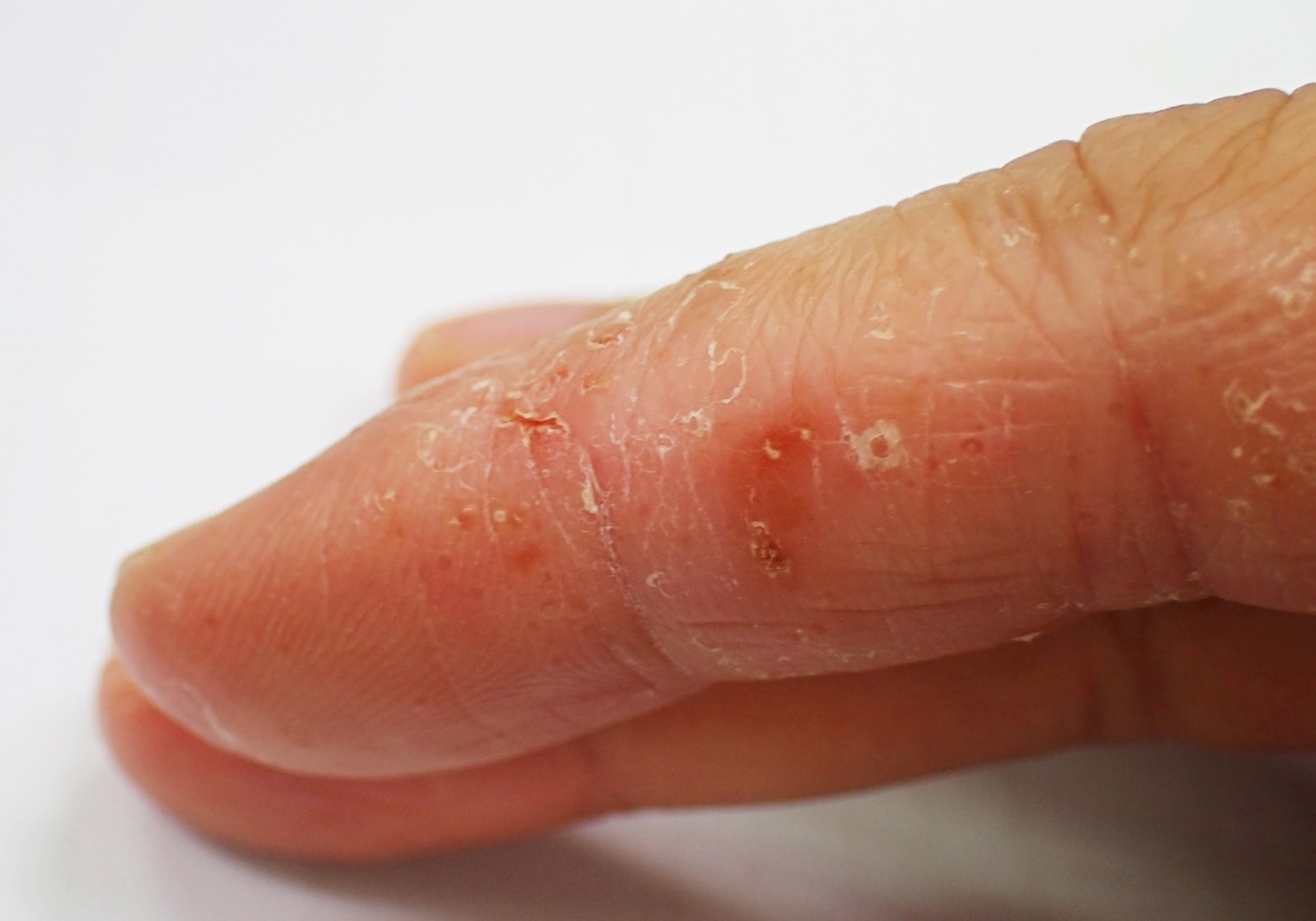 An example of Dyshidrotic Eczema on an index finger