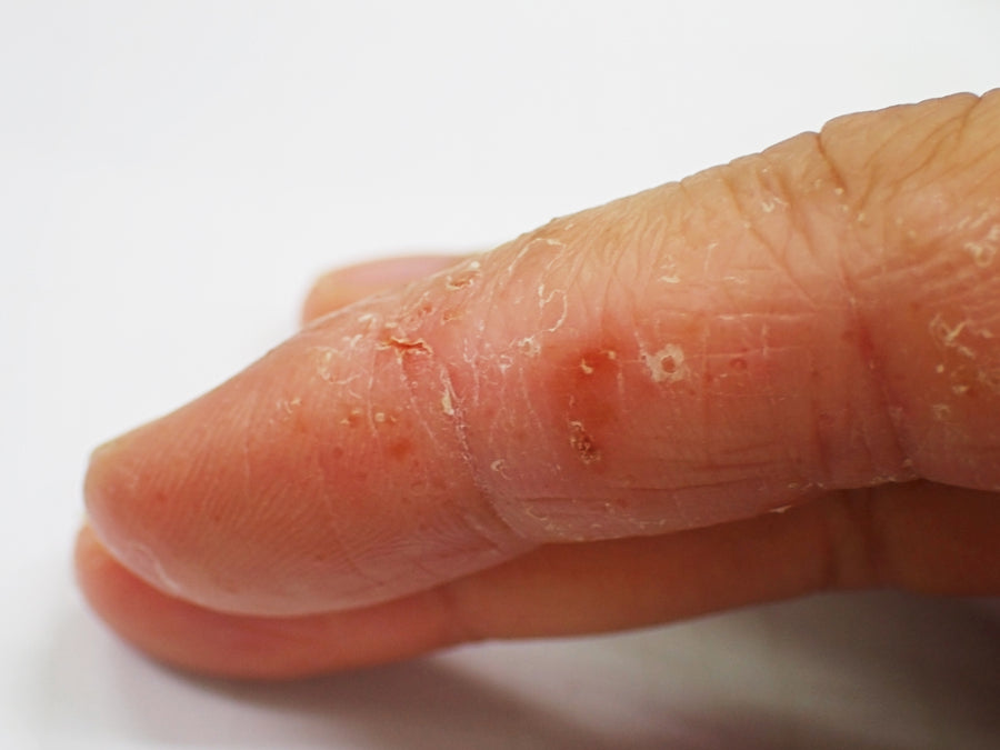 An example of Dyshidrotic Eczema on an index finger