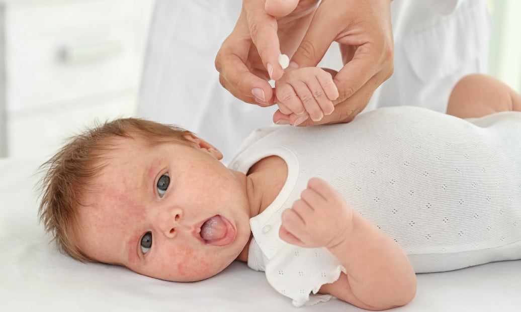 Baby with eczema laying on its back