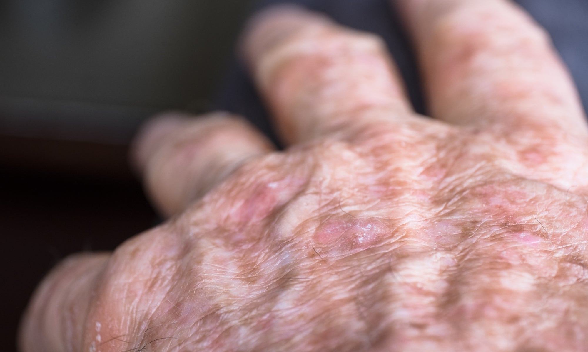 Actinic Keratosis on the hands