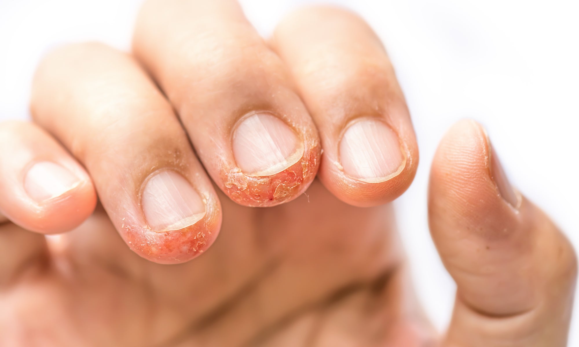 Dyshidrotic Eczema on fingers