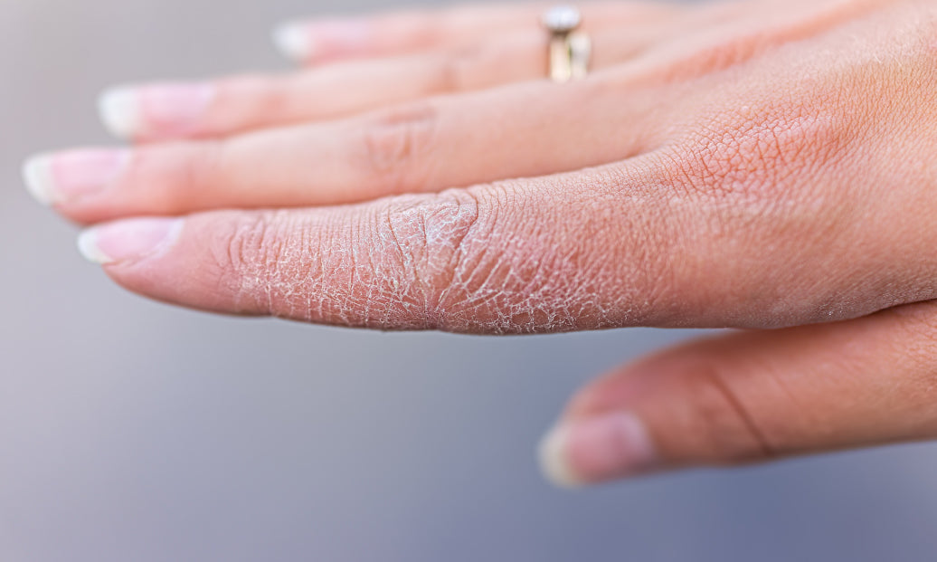 Dyshidrosis on the fingers