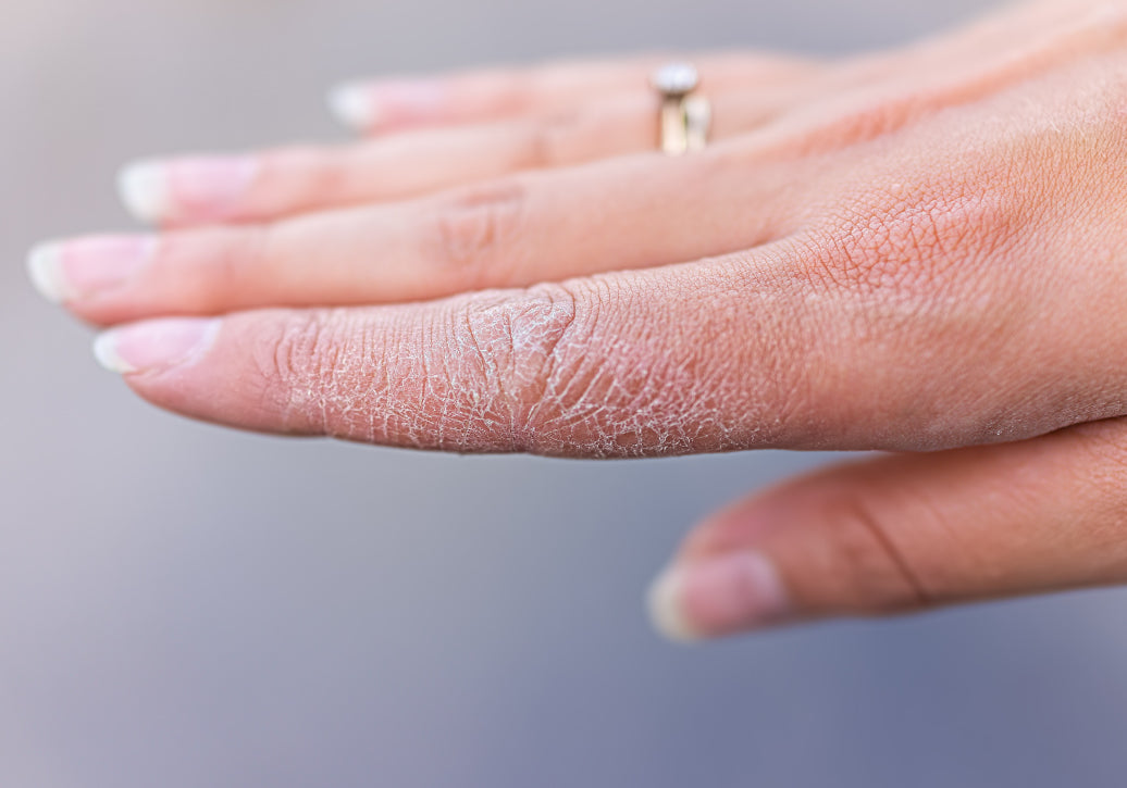 Dyshidrosis on the fingers