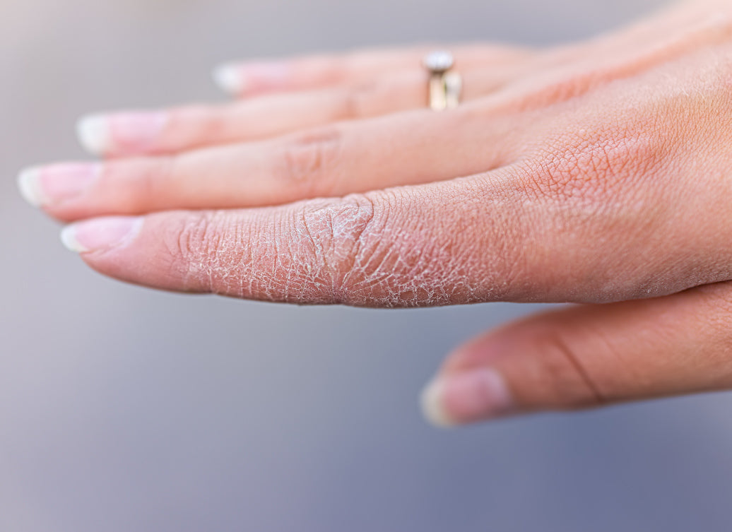What Is The Fastest Way To Cure Dyshidrosis? – Balmonds