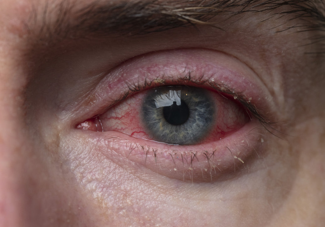 example of Blepharitis