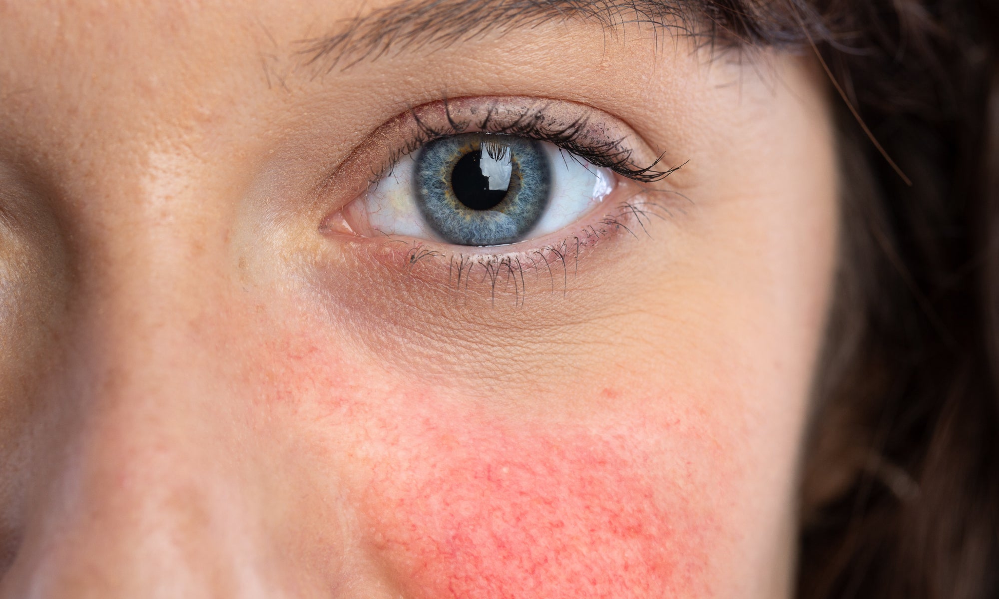 What Not To Eat When You Have Rosacea