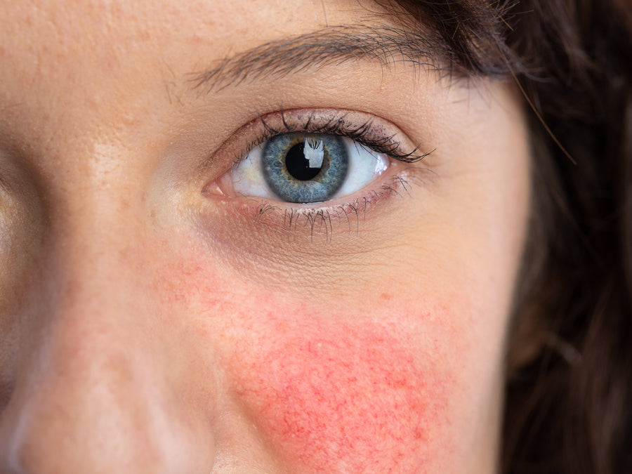 What Not To Eat When You Have Rosacea