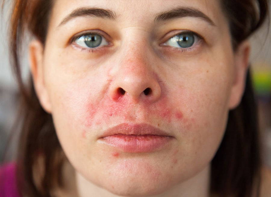 What Is The Best Face Wash For Perioral Dermatitis?