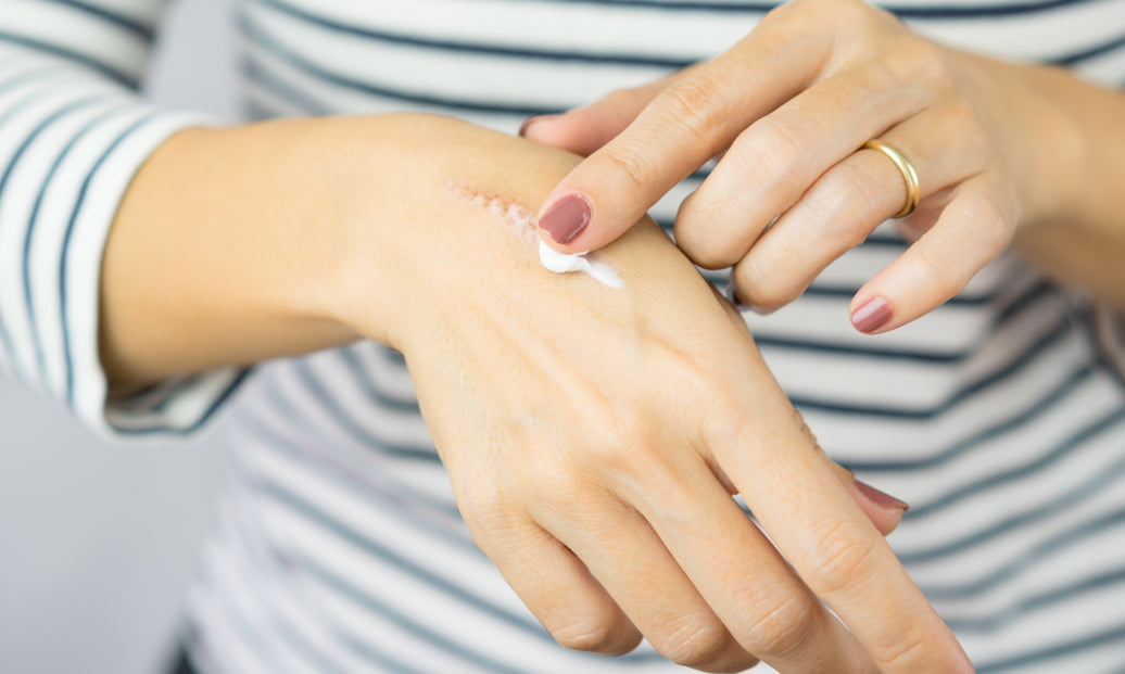 Applying cream to a scar on the back of a hand