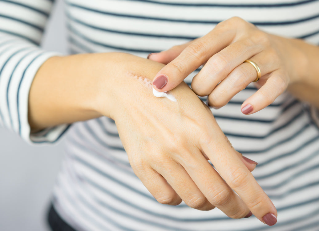 Applying cream to a scar on the back of a hand