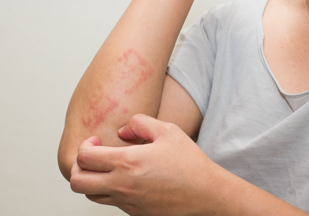 What’s Usually The First Sign Of Dermatitis?