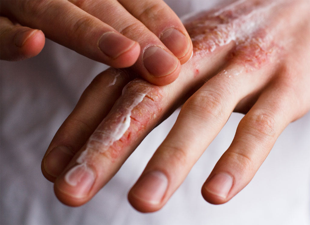 Which Hand Cream Is Best For Skin In Winter?