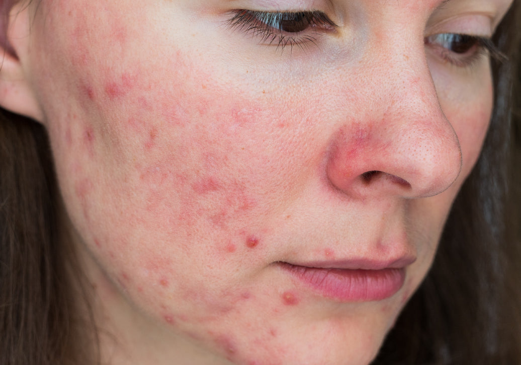 an example of rosacea on a cheek