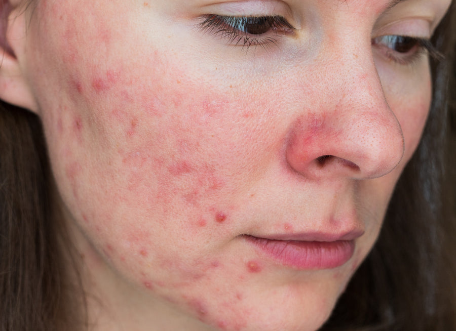 an example of rosacea on a cheek