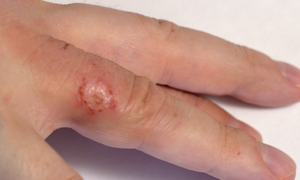 Nummular Eczema on the inside of an index finger