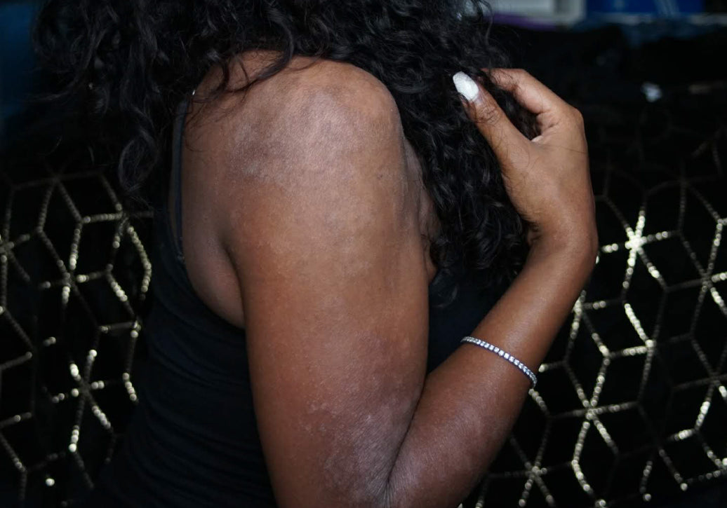 My Condition. My Colour. My Skin: A Personal Journey Through Eczema