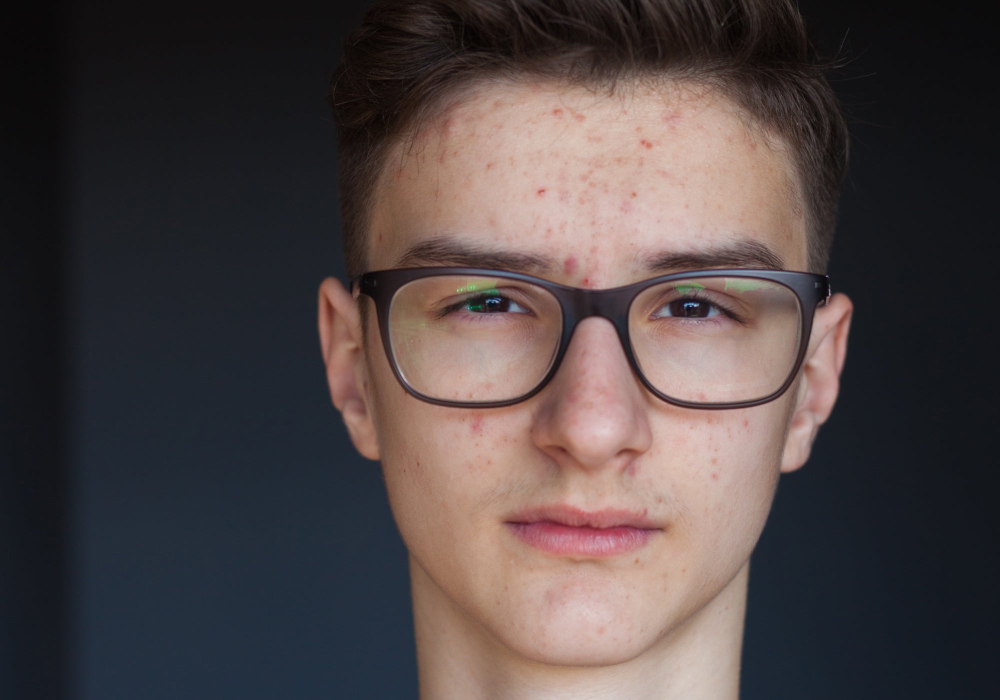 5 Tips For Treating Eczema When You Have Acne
