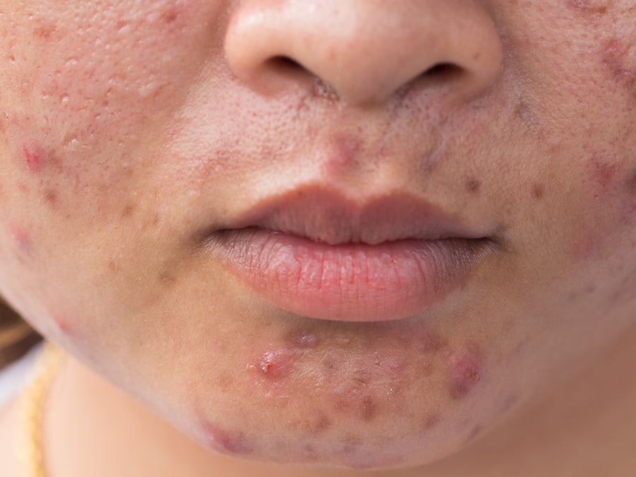 What Does Acne Rosacea Look Like?