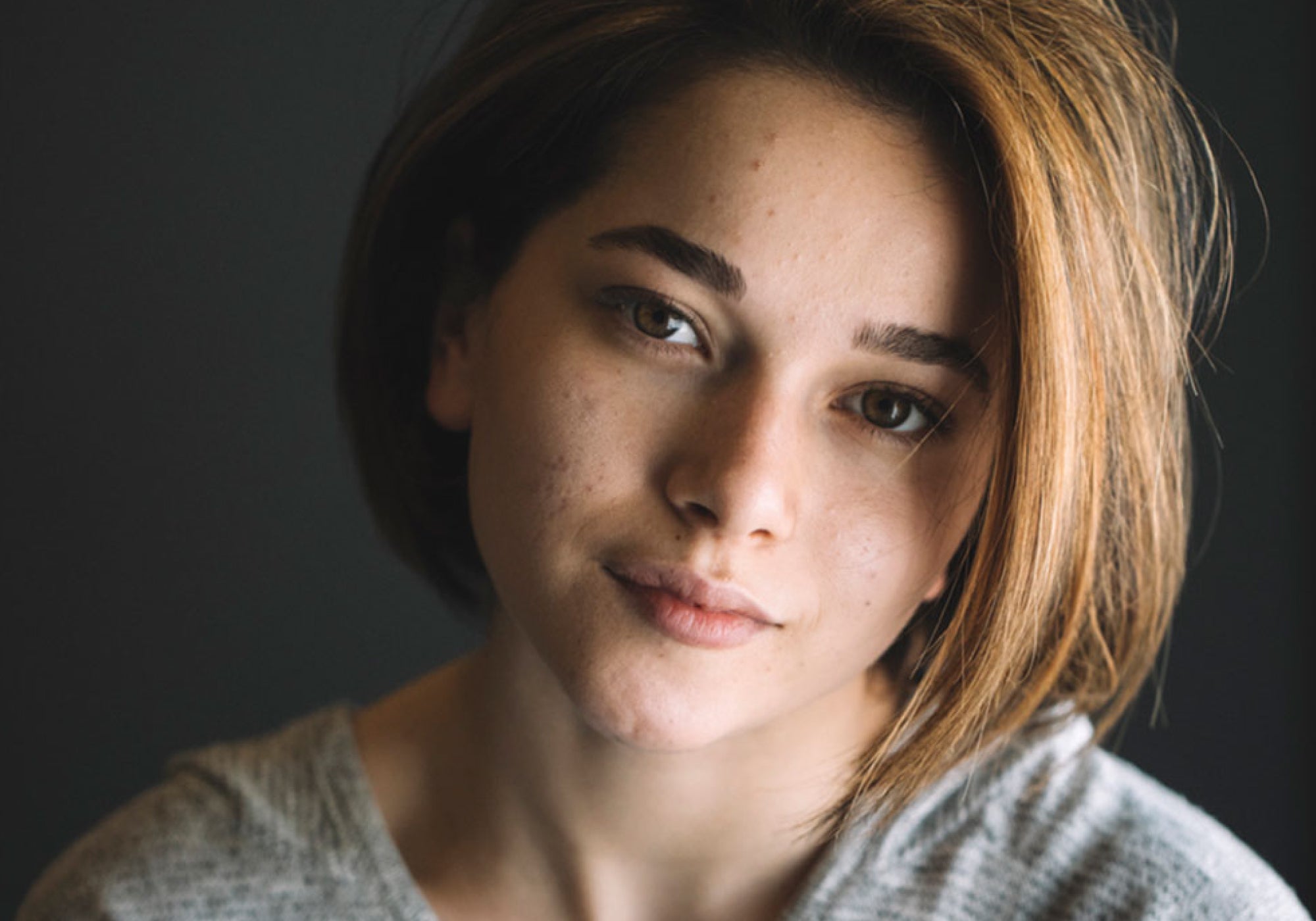 Does Eczema Cream Work For Acne?