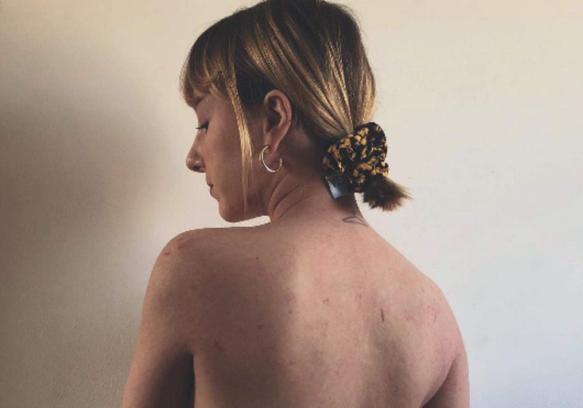 Eczema & Me: My Experience of Immunosuppressant Therapy