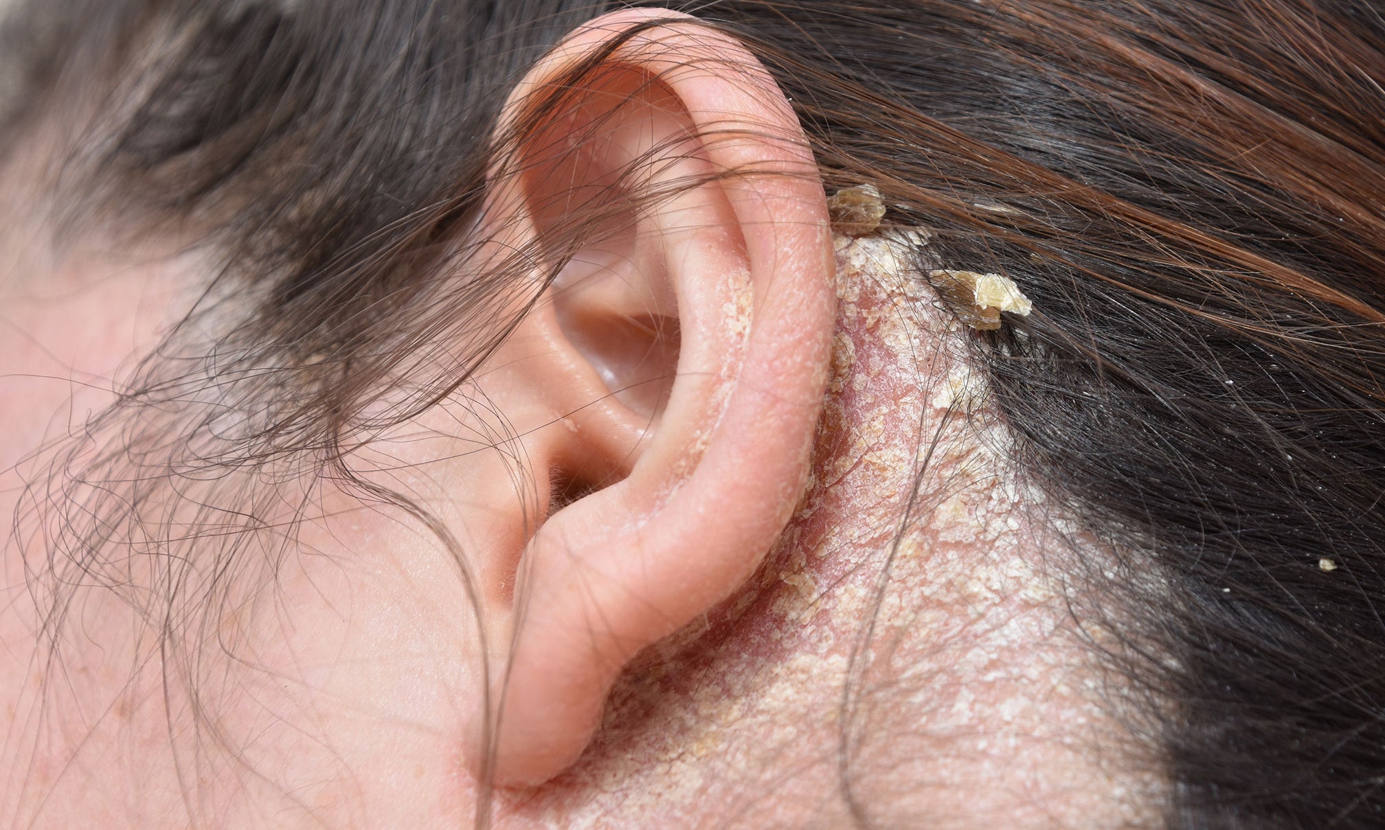 Are Fungal Infections on the Scalp Dangerous?