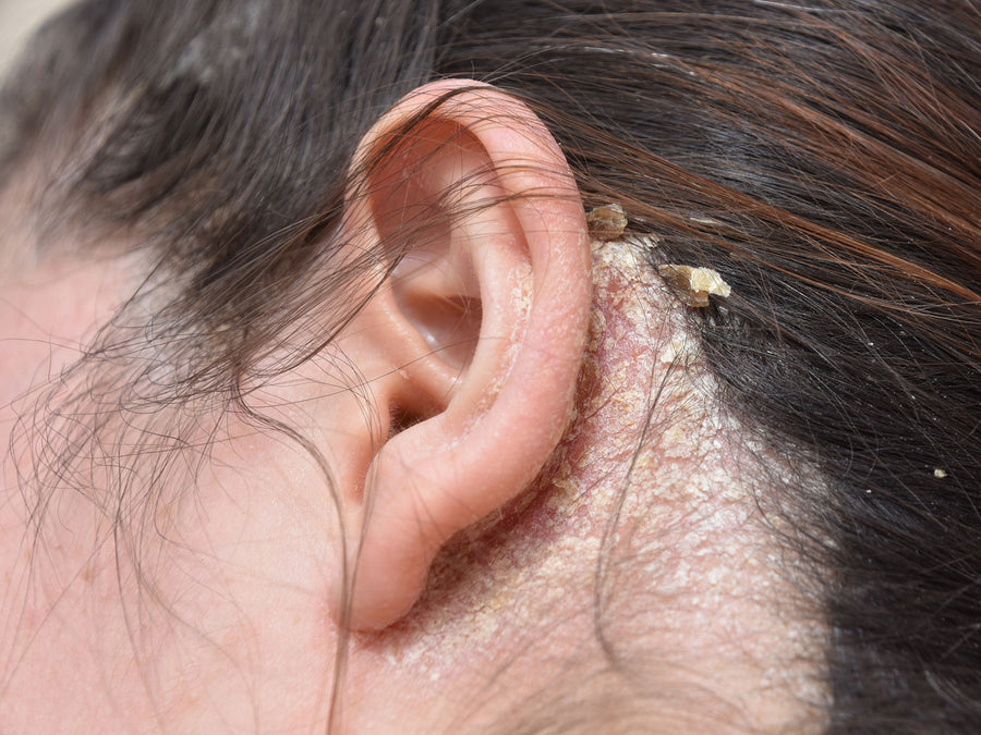 Are Fungal Infections on the Scalp Dangerous?