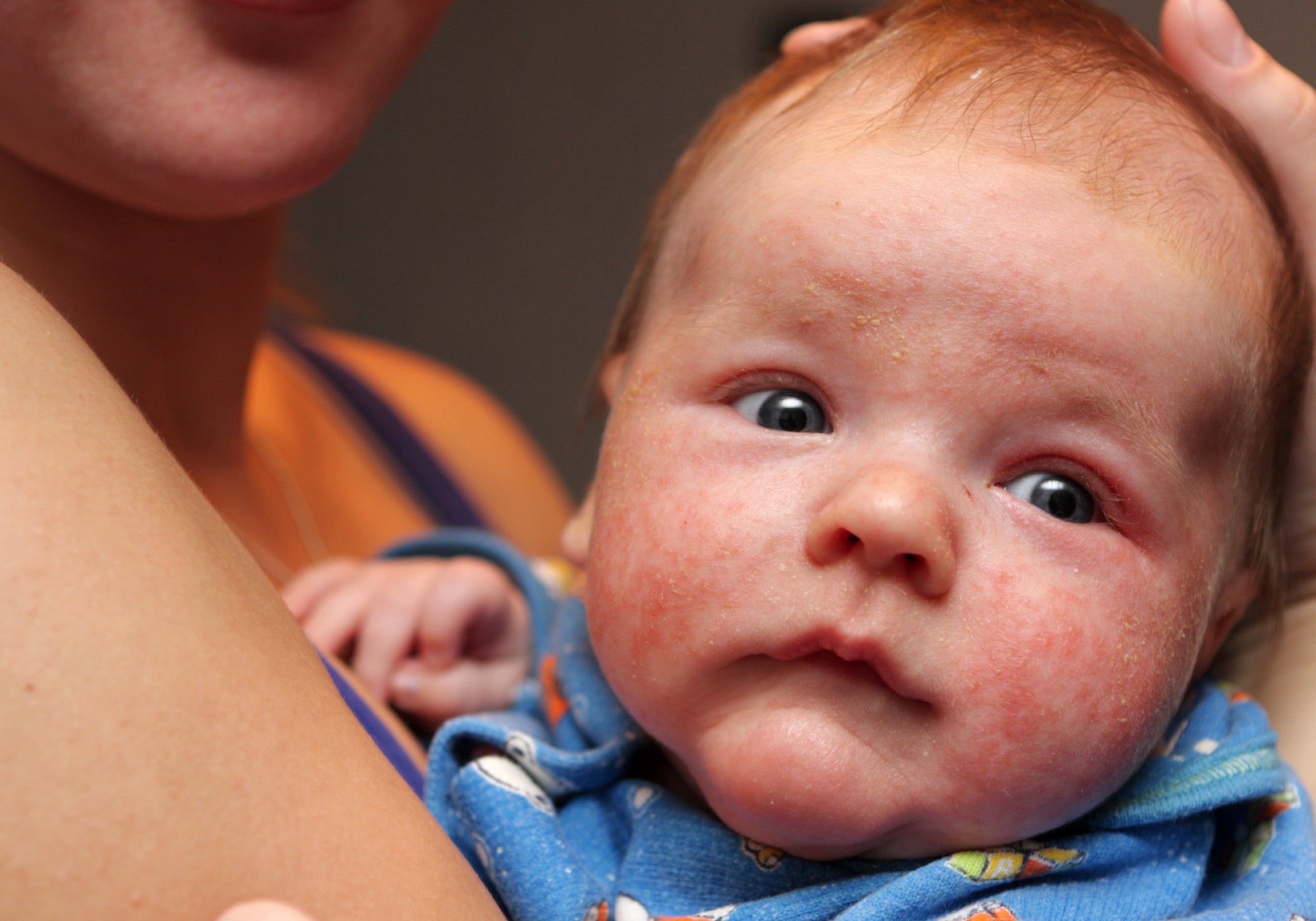 How To Soothe Topical Steroid Withdrawal In Babies