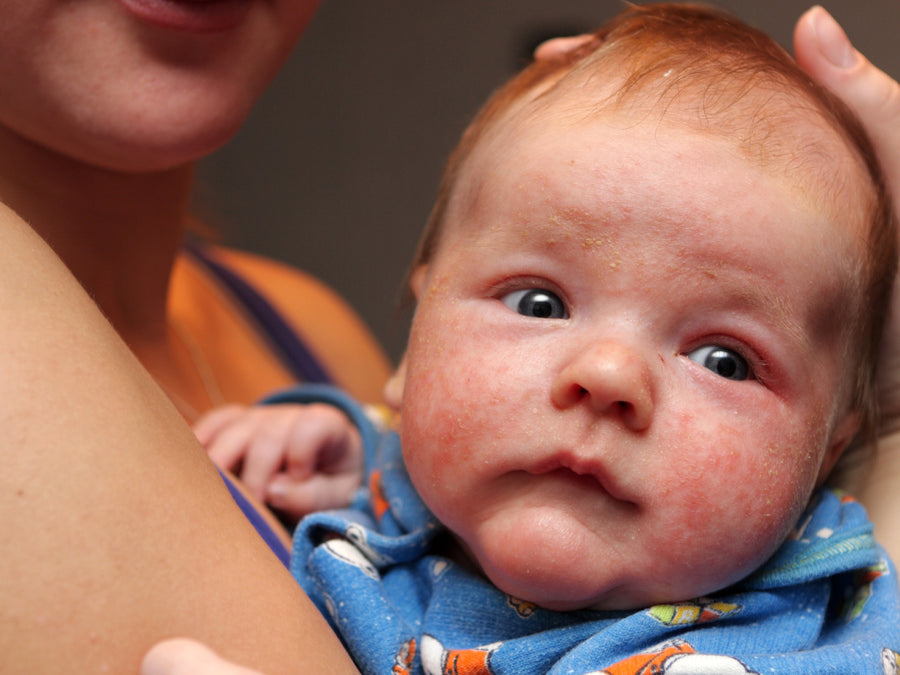 How To Soothe Topical Steroid Withdrawal In Babies