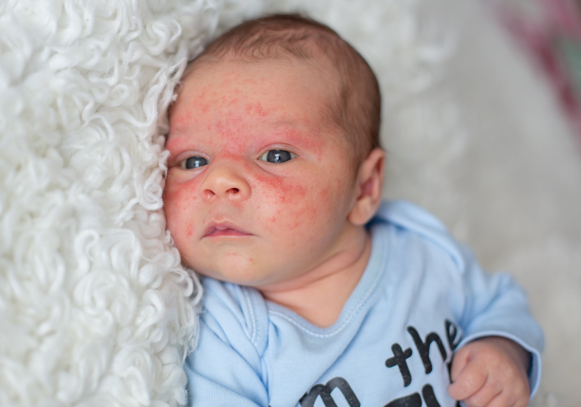 How To Tell If Your Baby Has Eczema or Infant Acne