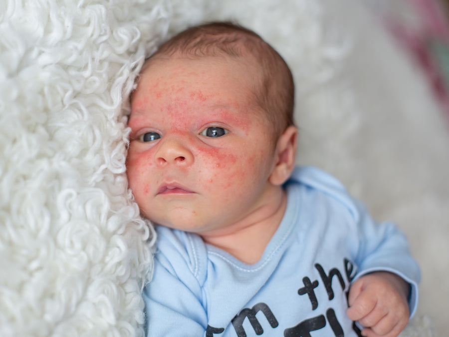 How To Tell If Your Baby Has Eczema or Infant Acne