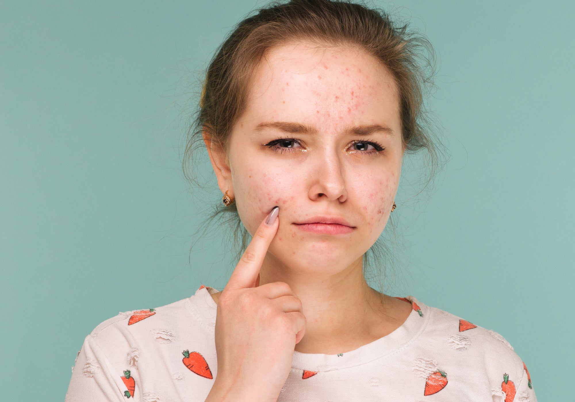 Best Natural Treatment For Acne And Face Eczema