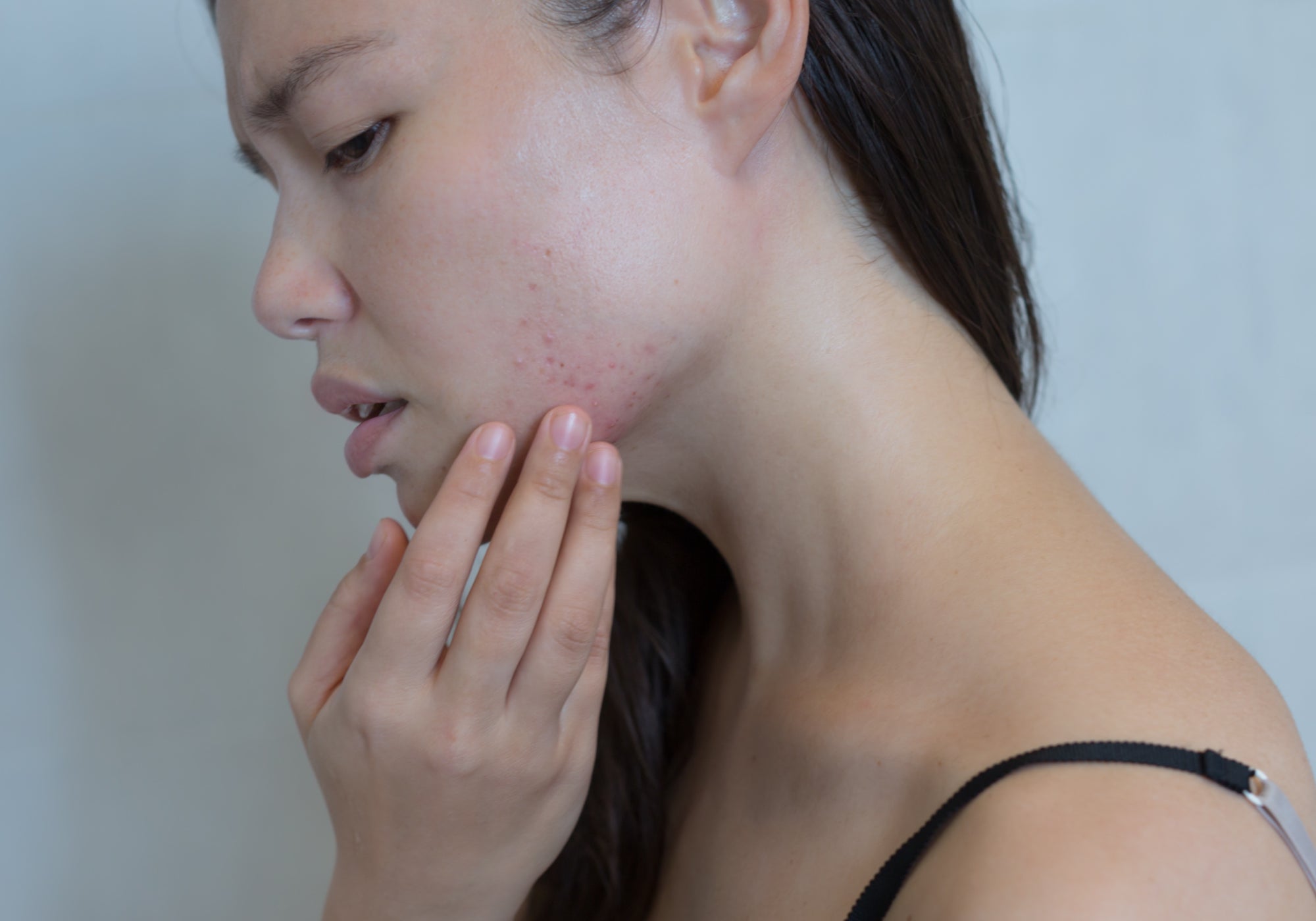 How To Get Rid Of Waxing Rash On Your Face During Lockdown