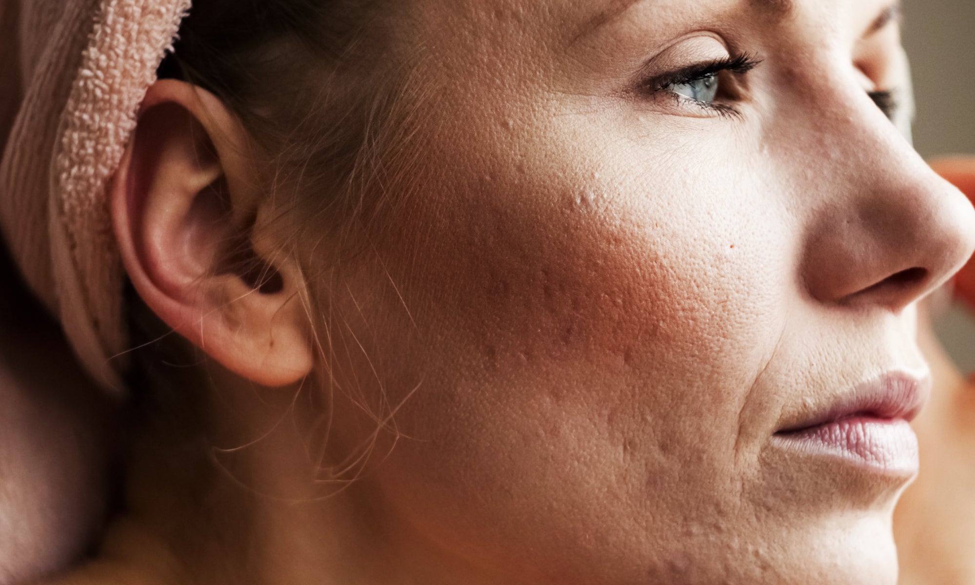 Top 6 Triggers of Acne Rosacea