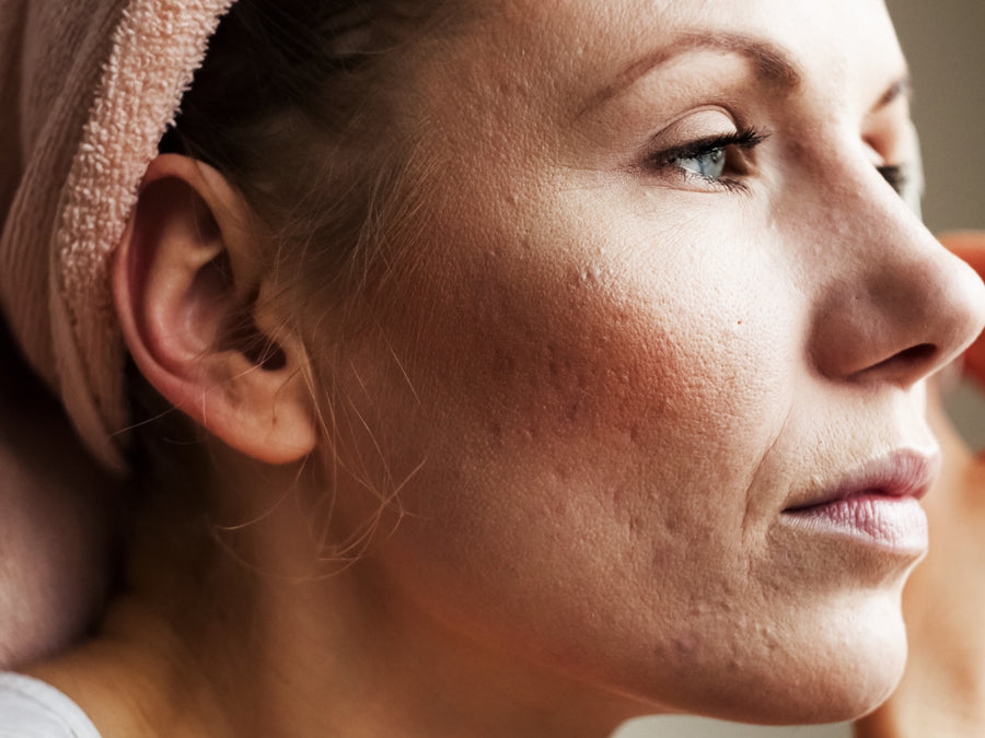 Top 6 Triggers of Acne Rosacea
