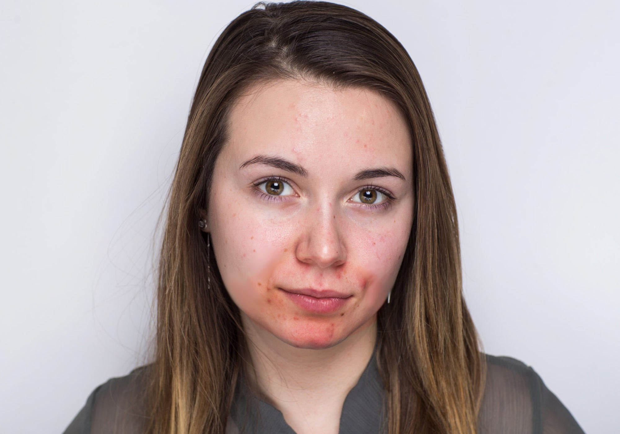 What is Acne Rosacea?