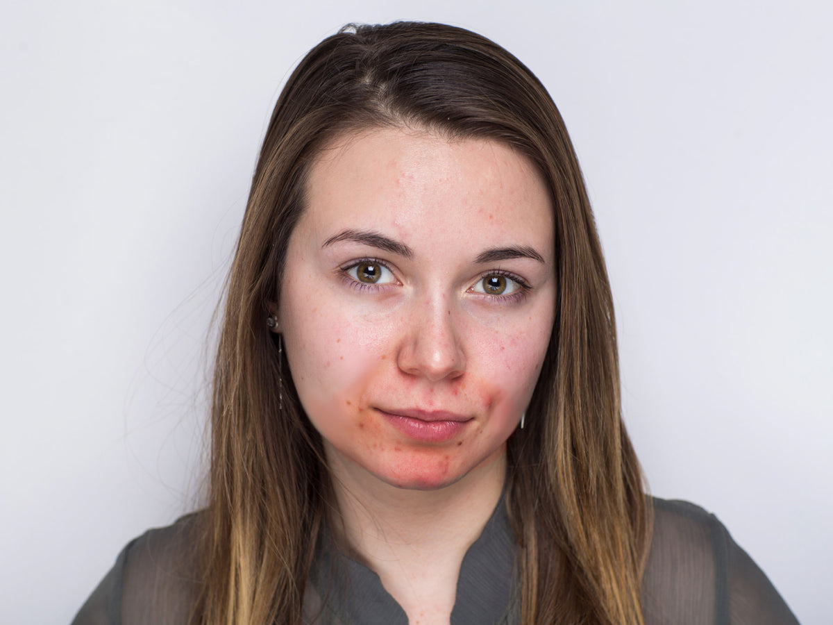 What is Acne Rosacea? – Balmonds
