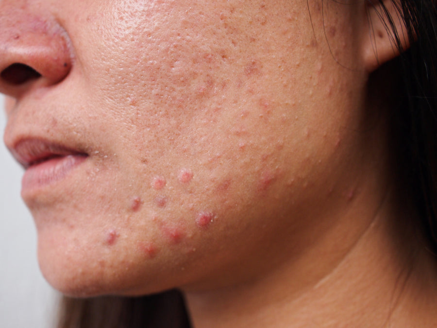 Is It Possible To Get Rid Of Acne Rosacea?