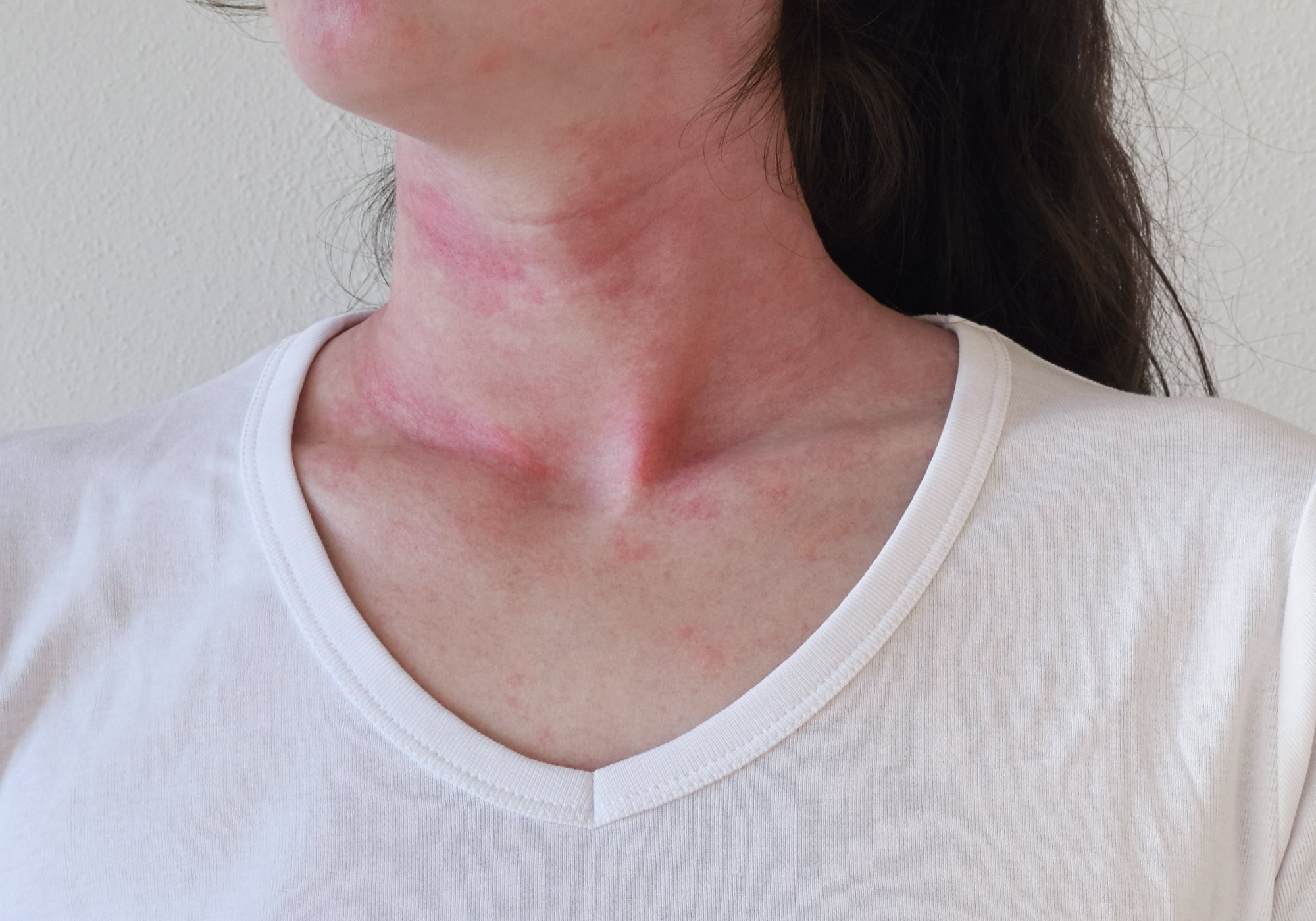 How Long Does No Moisture Therapy Take To Work?