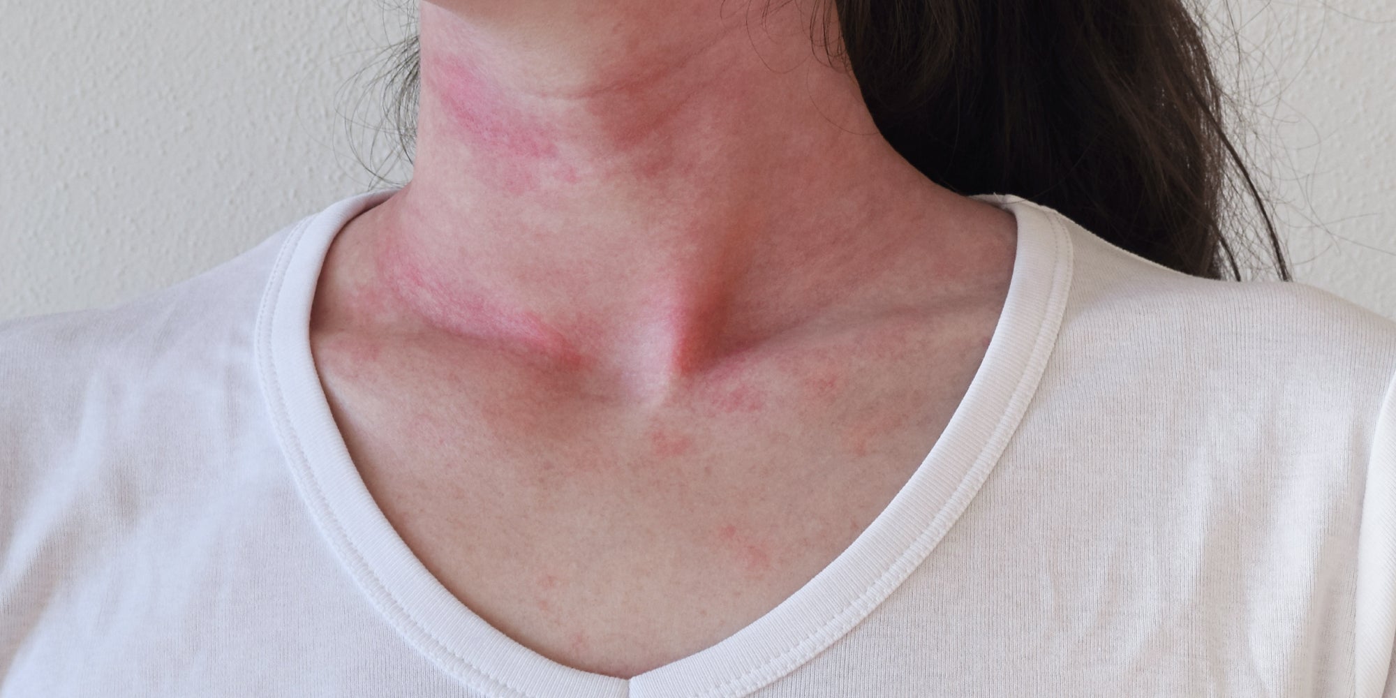 Identifying Triggers For Eczema Flare-Ups And Skin Sensitivities