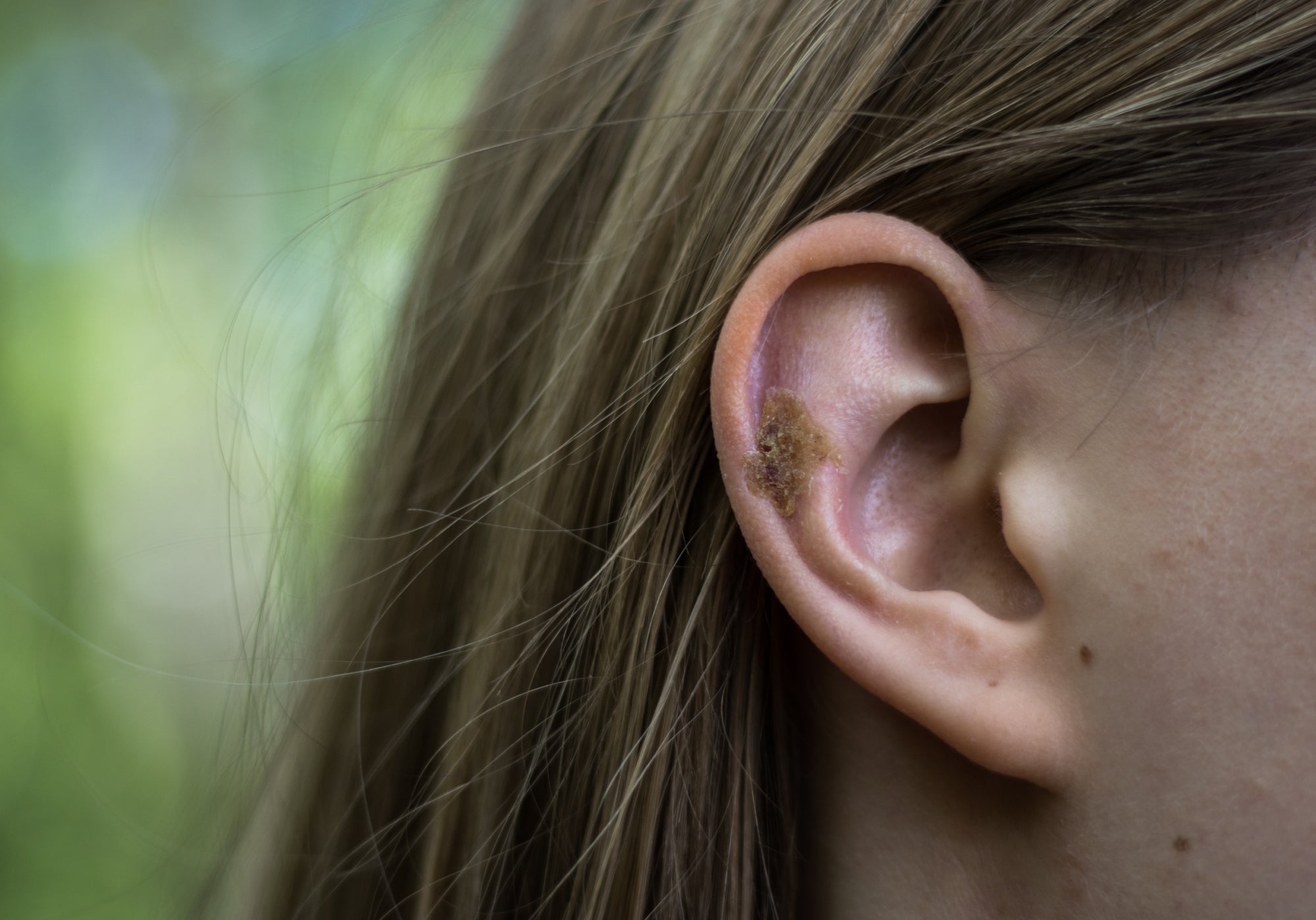 Is My Ear Eczema Infected? The Signs And Symptoms Of Aural Dermatitis 