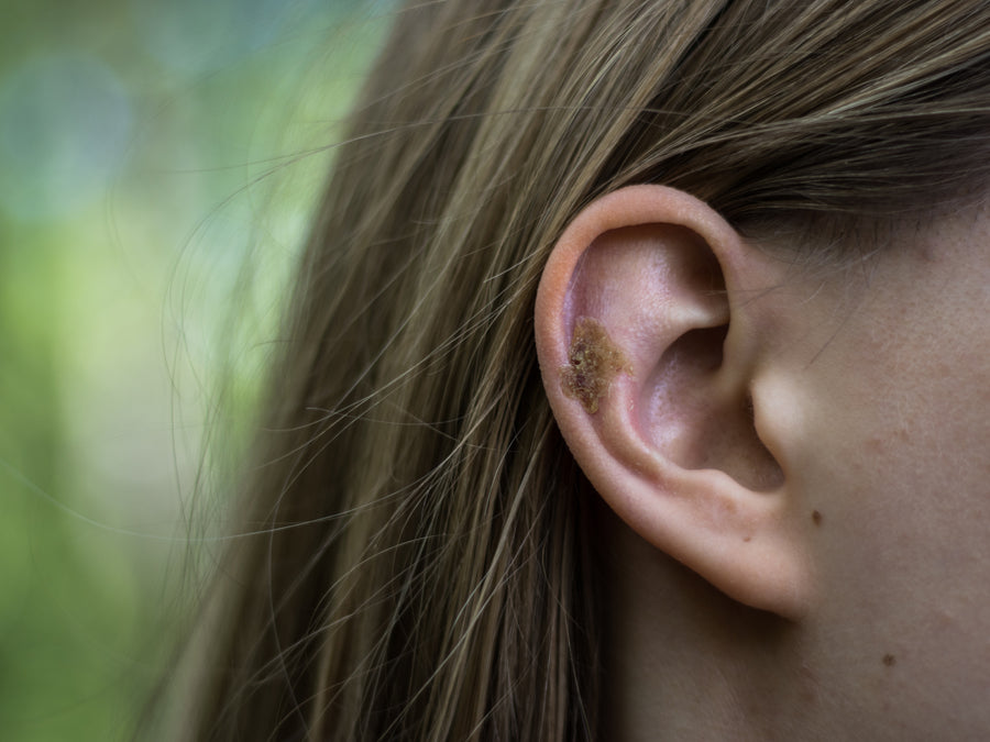 Is My Ear Eczema Infected? The Signs And Symptoms Of Aural Dermatitis 